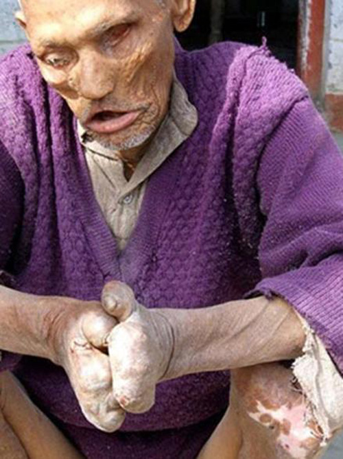 leper